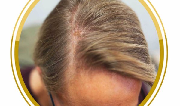 Nachher vorher minoxidil geheimratsecken Haartransplantation Geheimratsecken: